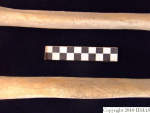 L_V20d5096 A16.175 R827 lR at tibiae shaft, anterior view.JPG L_V20d5096 A16.175 R827 lR at tibiae shaft, anterior view